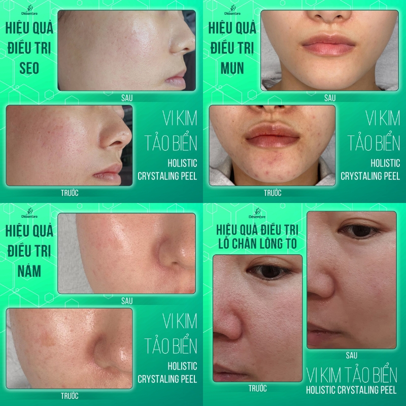 Hiệu quả khi dùng bộ vi kim nano Desembre