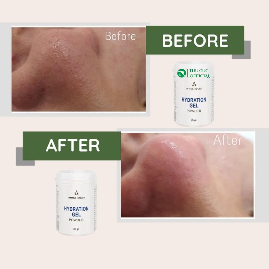 Hiệu quả sử dụng ủ mụn Anna Lotan