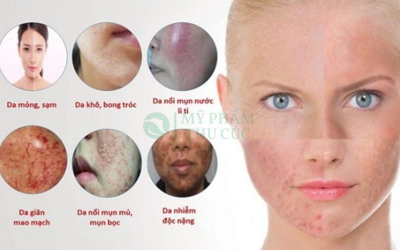 Cấp độ nhiễm Corticoid
