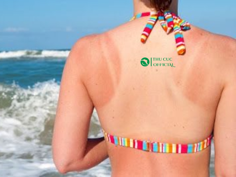 Da cháy nắng sau khi đi tắm biển