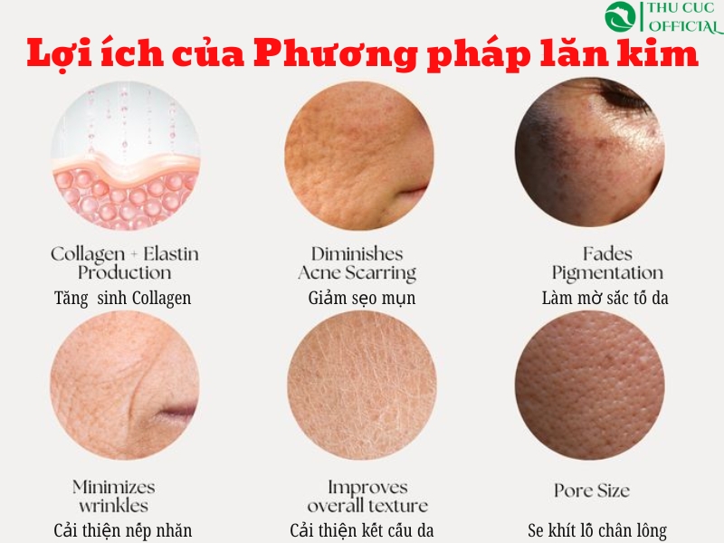 Phương pháp lăn kim