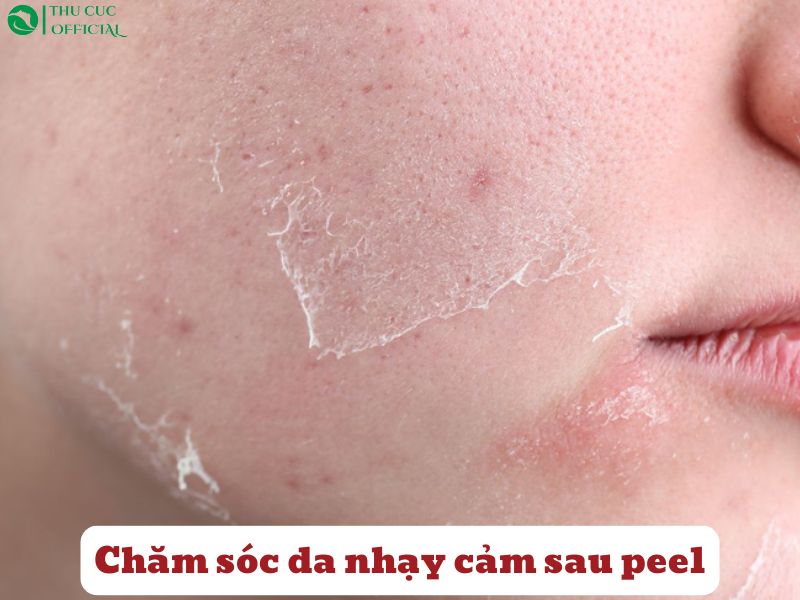 Chăm sóc da nhạy cảm sau peel