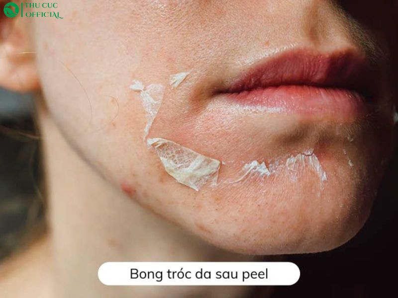 Tình trạng da bong tróc sau peel