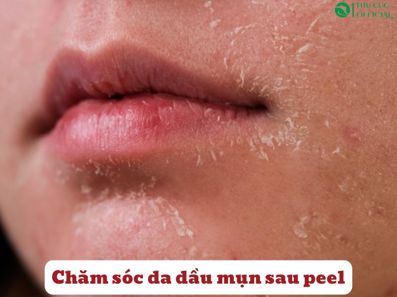Chăm sóc da dầu sau peel