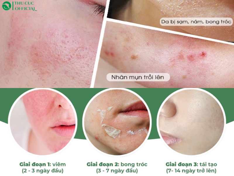 Vì sao phải chăm sóc da sau peel