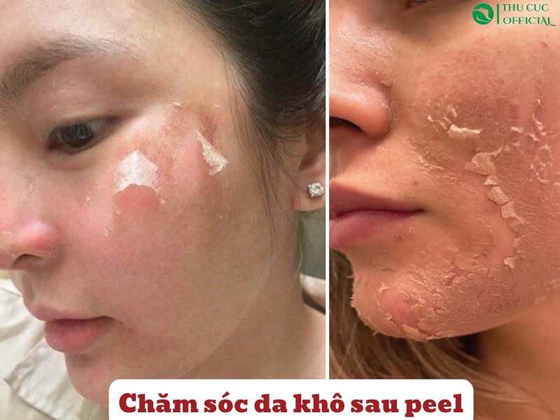 Chăm sóc da khô sau peel