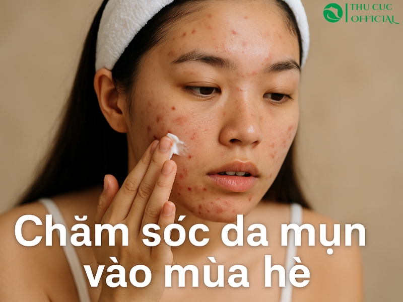 Chăm Sóc Da Mụn Vào Mùa Hè