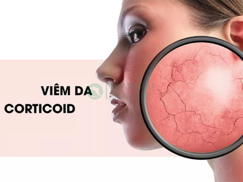 Da nhiễm Corticoid