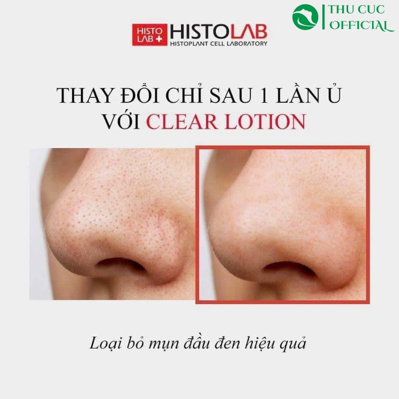Hiệu quả dùng ủ mụn Histolab