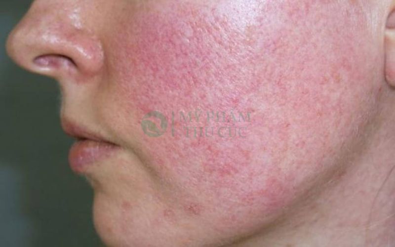 Hình ảnh da nhiễm Corticoid