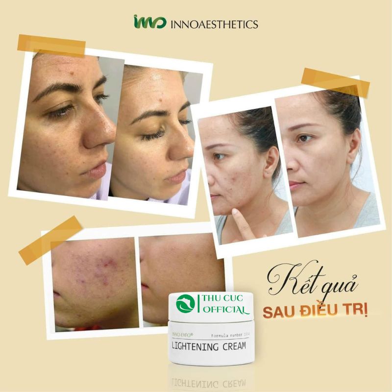 Peel da Innoaesthetics Lightening 15g