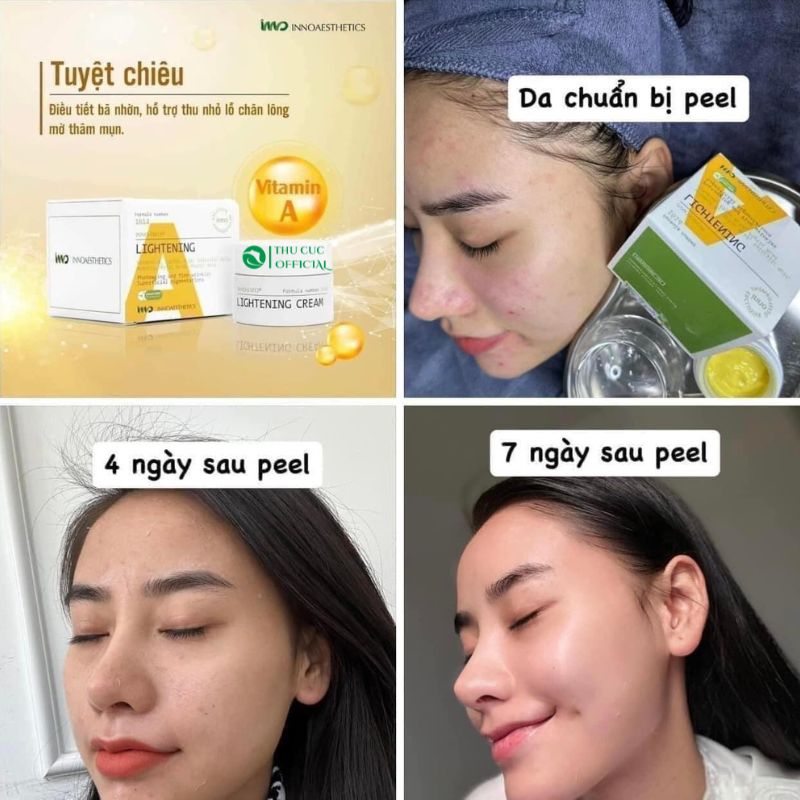 Hiệu quả sử dụng peel chữ A