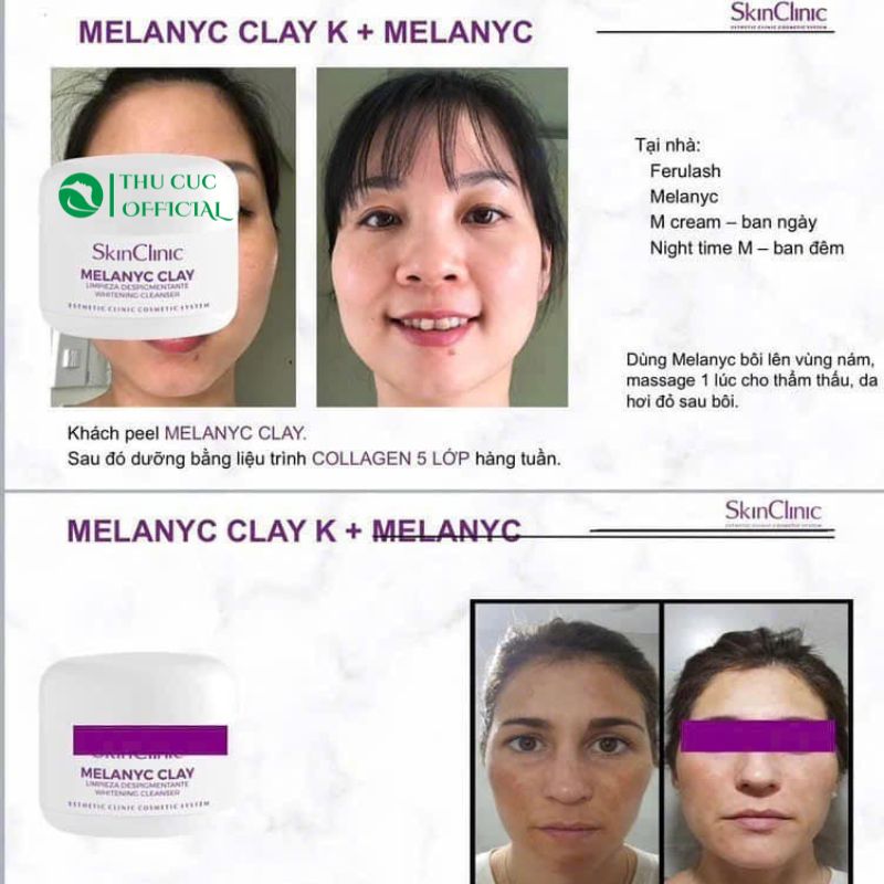 Peel da SkinClinic  cho da nám