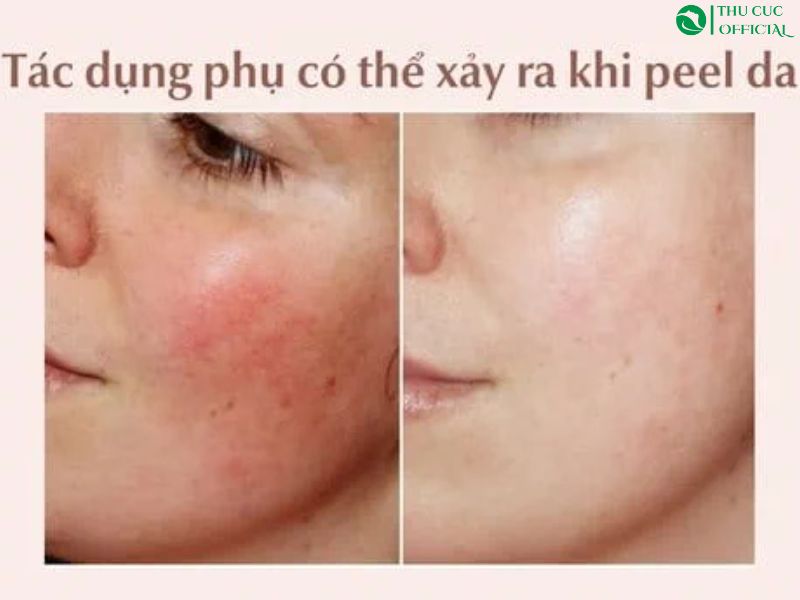 Rủi Ro Và Biến Chứng Khi Peel Da Tại Nhà