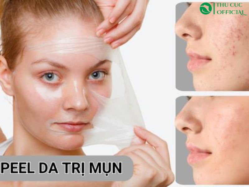 Peel da trị mụn