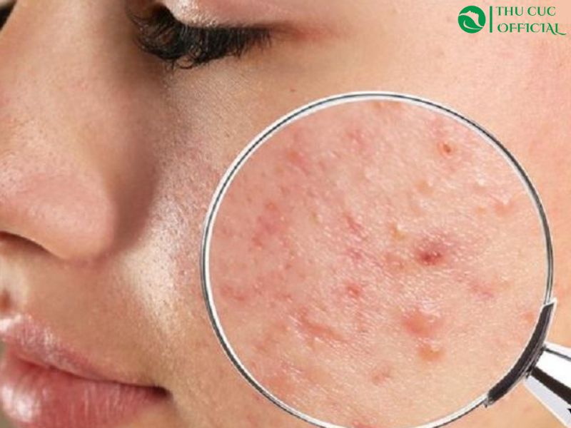 Tình trạng da cần điều trị trước khi peel