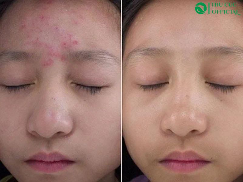 Peel da mụn tại nhà