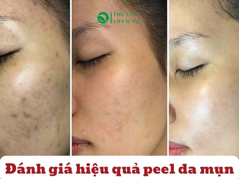 Đánh giá hiệu quả Peel da mụn