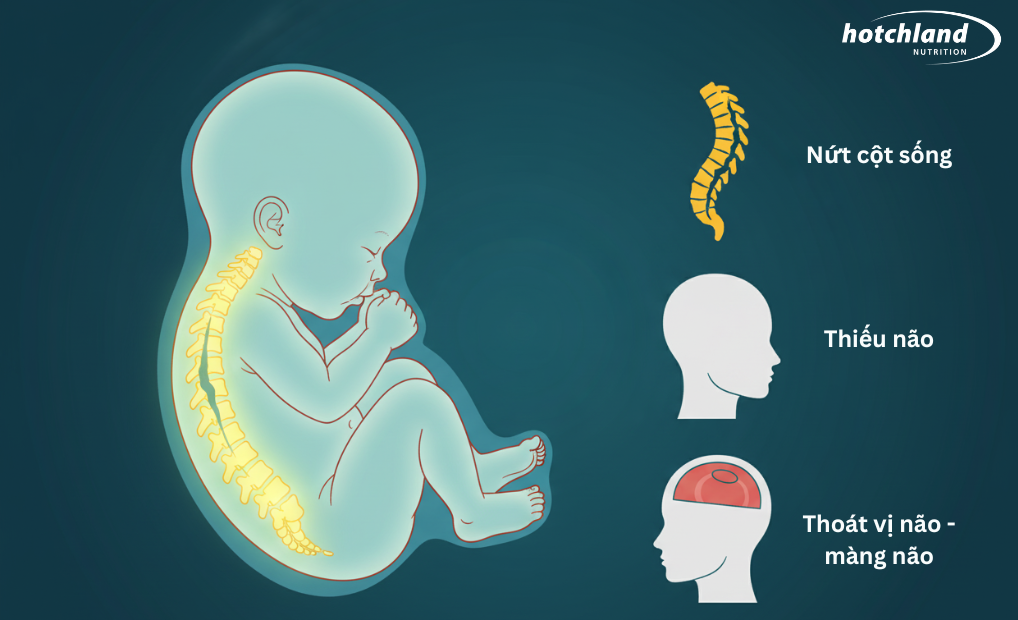 Dị tật ống thần kinh ở thai nhi