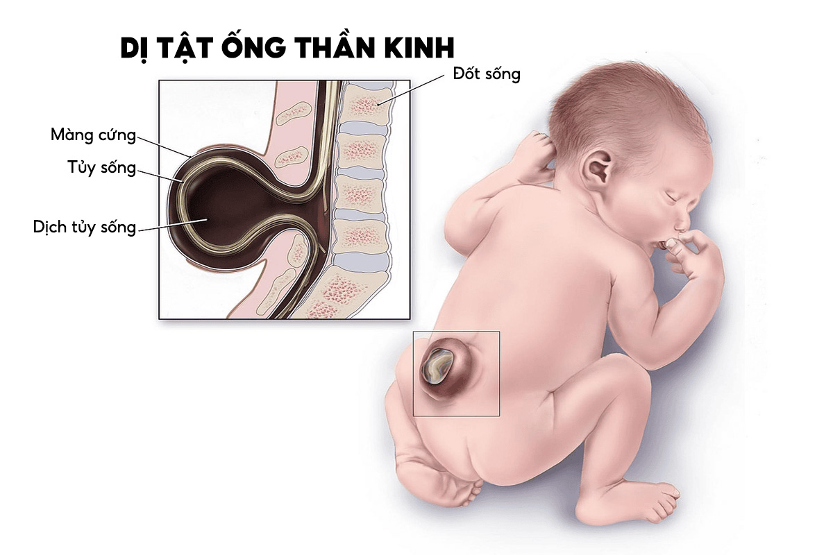 Vitamin B9 (Folate) – Ngăn ngừa dị tật ống thần kinh