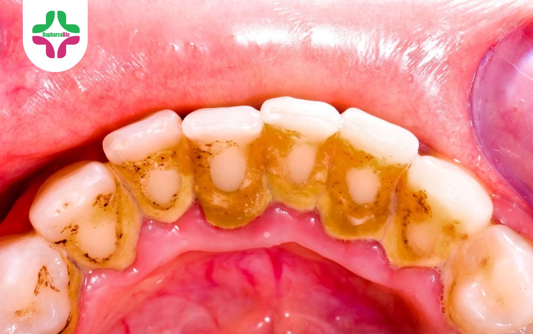 10-bien-phap-tu-nhien-loai-bo-cao-rang-va-duy-tri-suc-khoe-rang-mieng-tai-nha