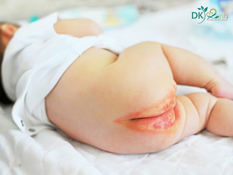 Bé sơ sinh bị hăm tã sẽ có những dấu hiệu nào