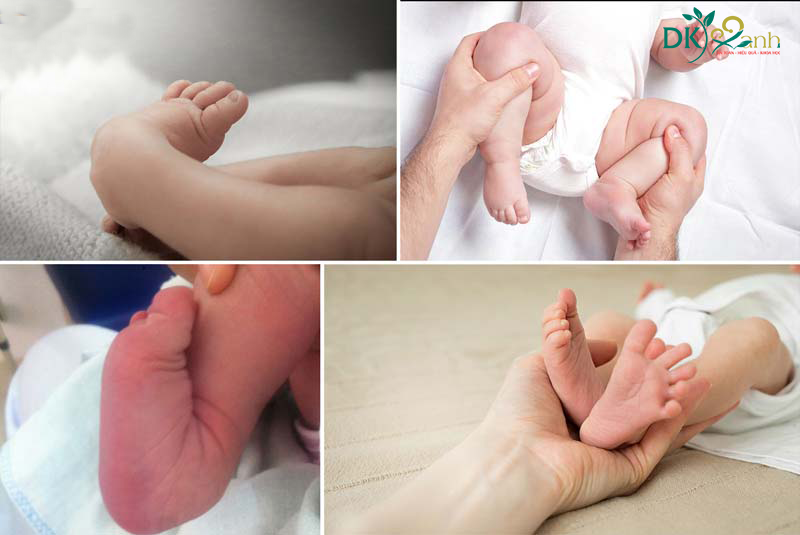 Các dị tật bẩm sinh ở trẻ