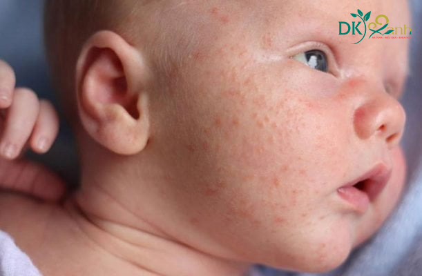 Chàm sữa ở trẻ sơ sinh