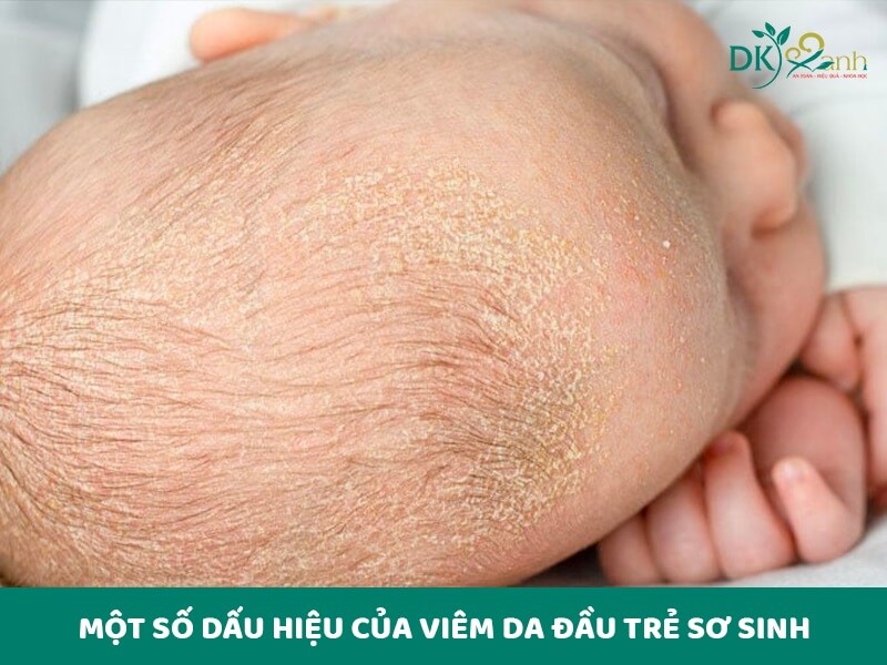 Một số dấu hiệu của viêm da đầu trẻ sơ sinh