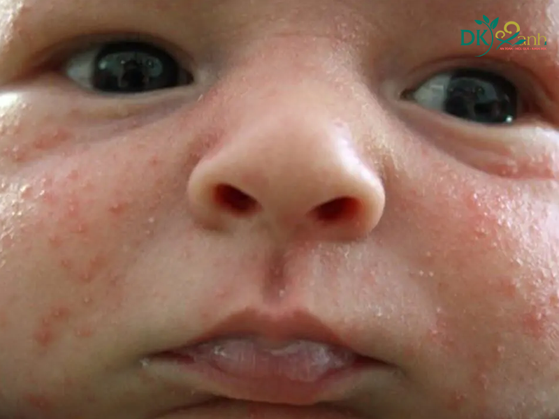 Mụn trứng cá của trẻ sơ sinh