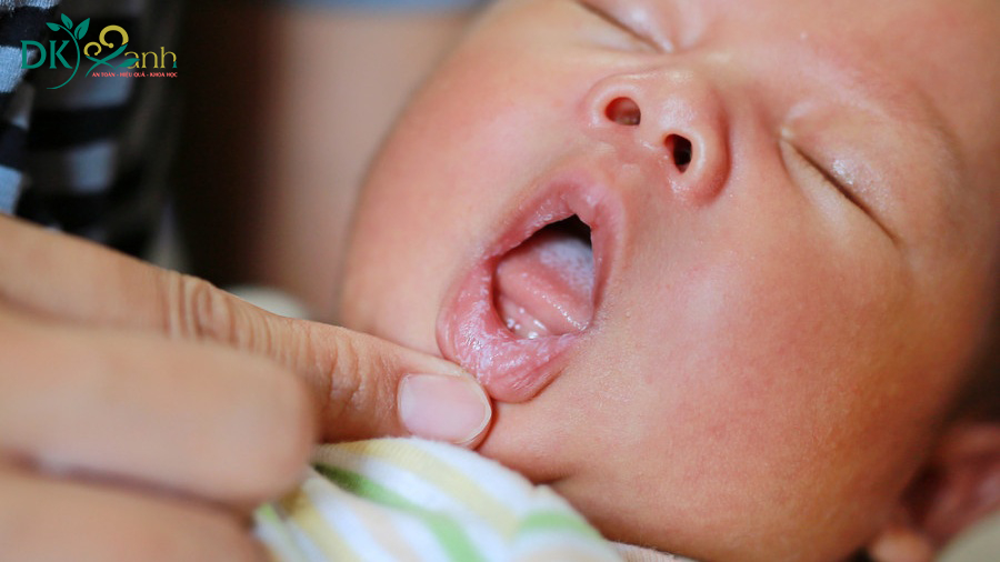 Nguyên nhân hình thành rơ lưỡi ở trẻ