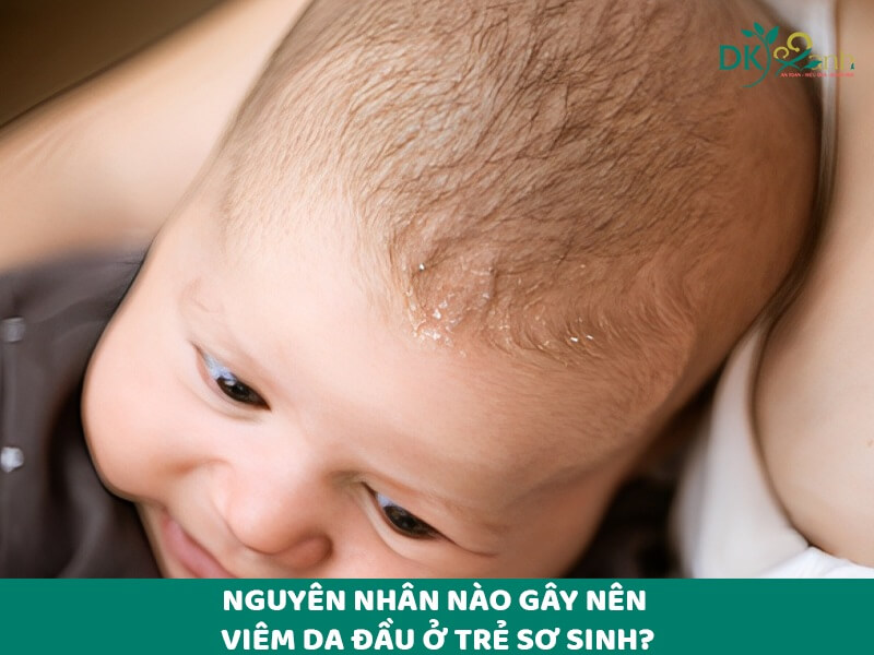 Nguyên nhân nào gây nên viêm da đầu ở trẻ sơ sinh