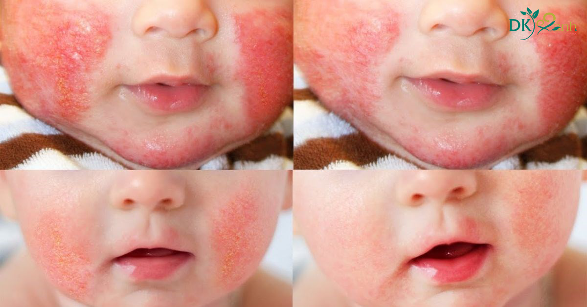 Nguyên nhân trẻ sơ sinh bị chàm sữa