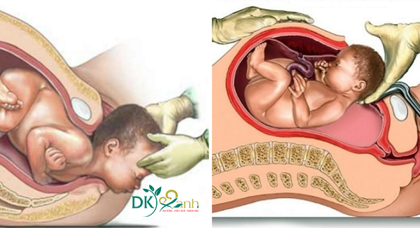 Sự khác nhau giữa sinh mổ và sinh thường