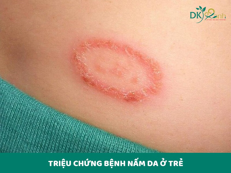 Triệu chứng bệnh nấm da ở trẻ