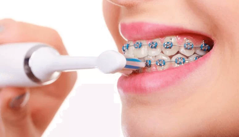 bàn chải điện phù hợp với chỉnh nha