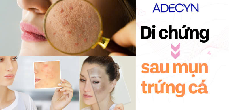 CÁC DI CHỨNG SAU MỤN  TRỨNG CÁ