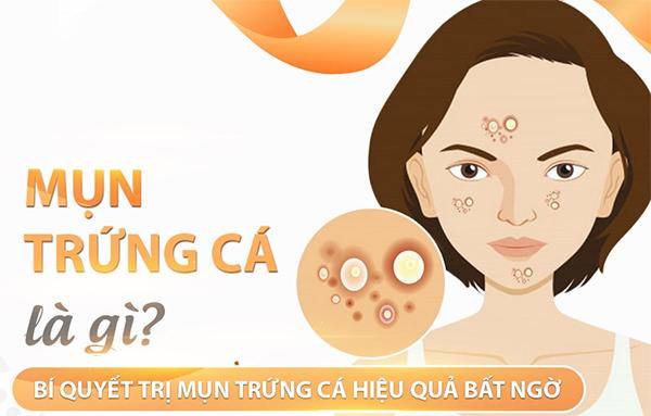 MỤN TRỨNG CÁ