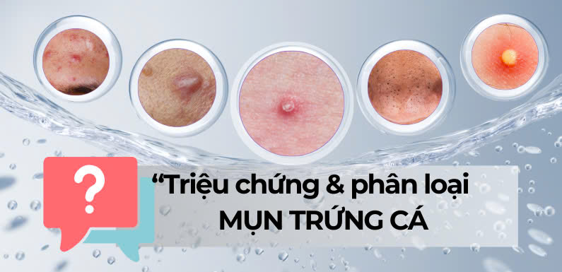TRIỆU CHỨNG VÀ PHÂN LOẠI MỤN TRỨNG CÁ