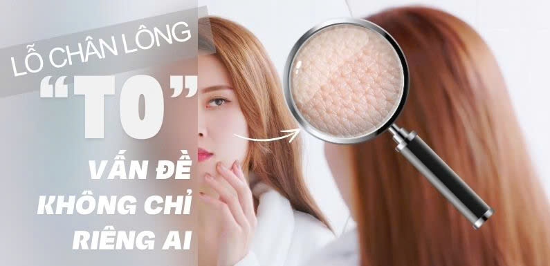 LỖ CHÂN LÔNG TO- VẤN ĐỀ KHÔNG CỦA RIÊNG AI