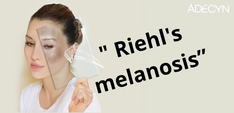RIEHL’S MELANOSIS