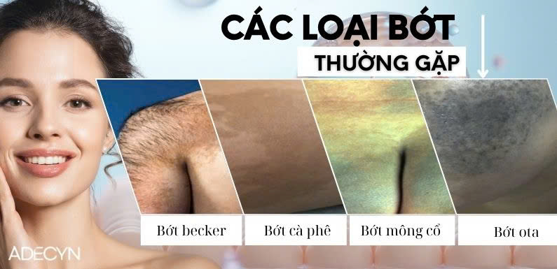 CÁC LOẠI BỚT SẮC TỐ THƯỜNG GẶP