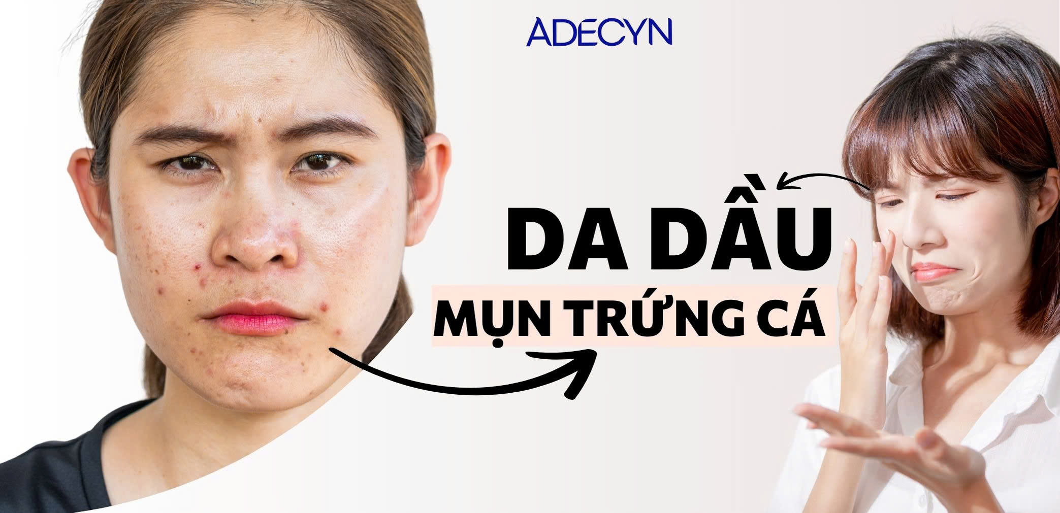 Da dầu và mụn trứng cá