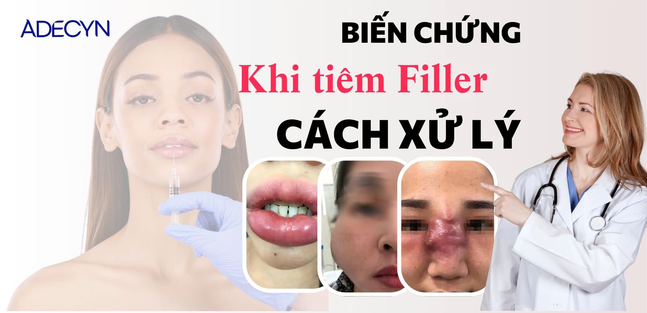 Biên chứng do tiêm Filler và cách xử trí