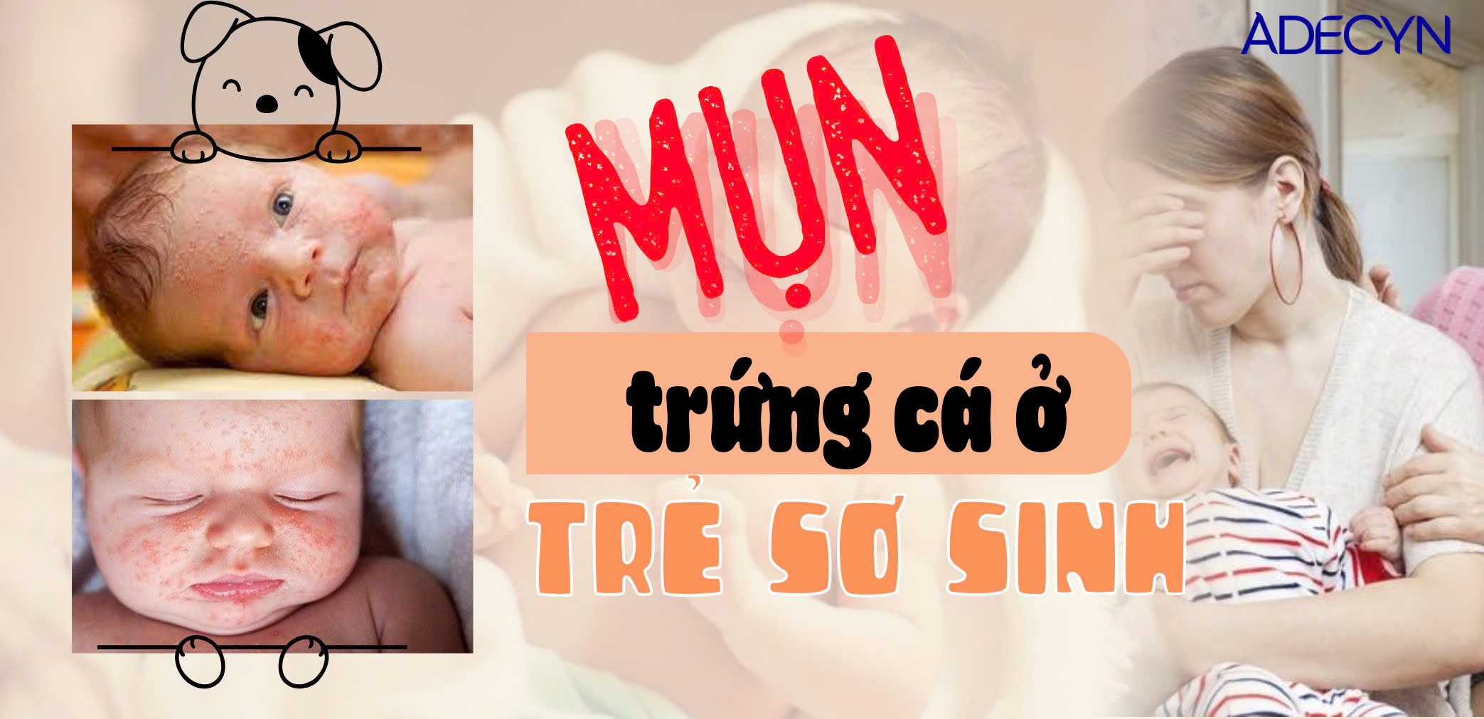 Mụn trứng cá ở trẻ sơ sinh