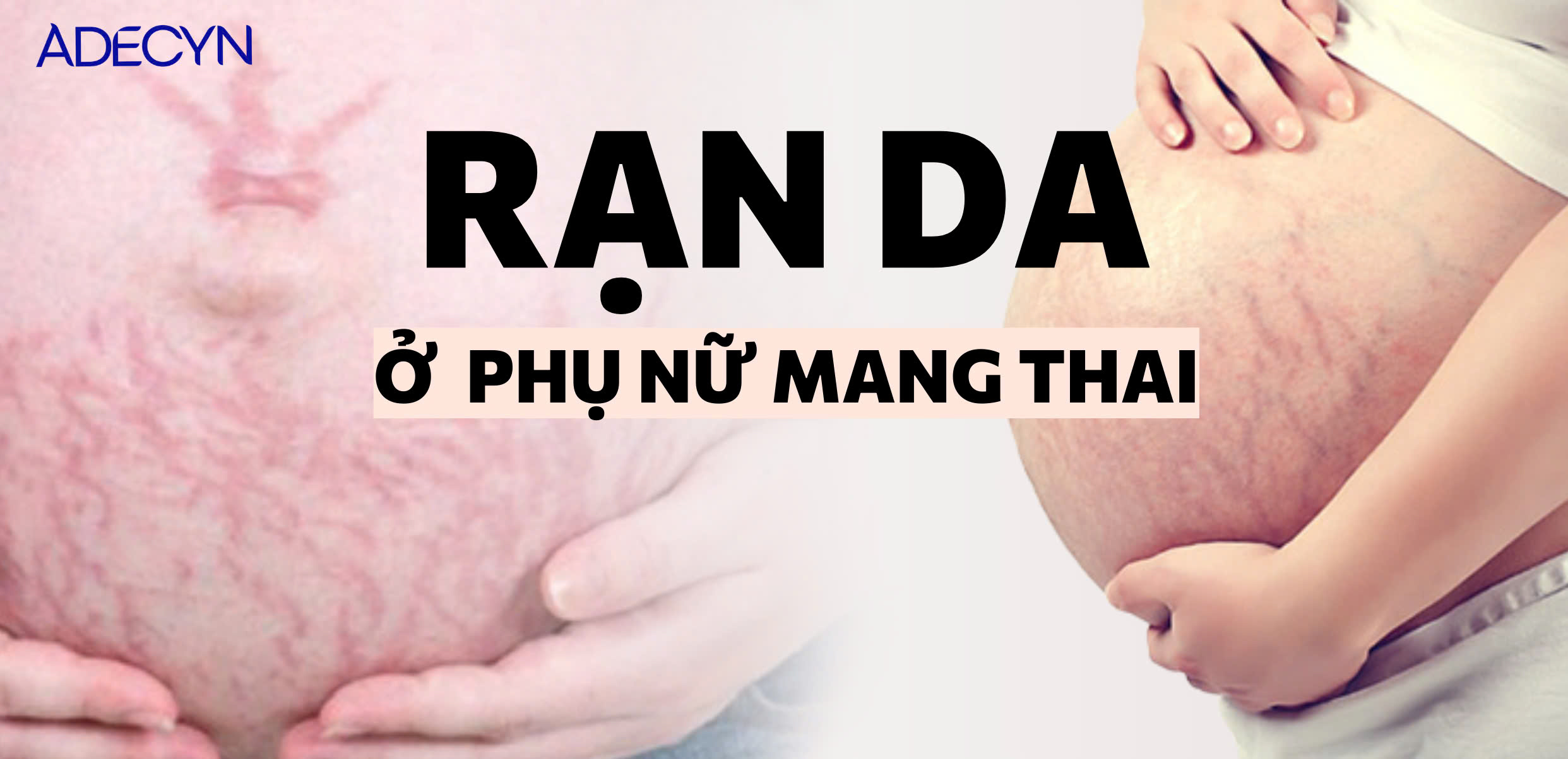 Rạn da ở phụ nữ có thai