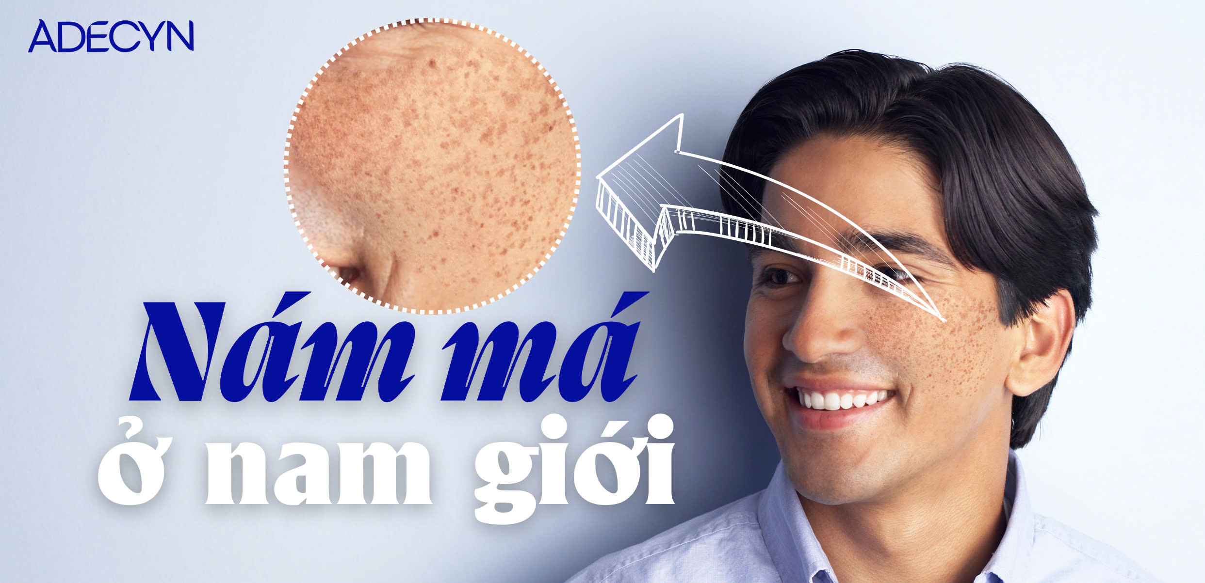 Rám má ở nam giới