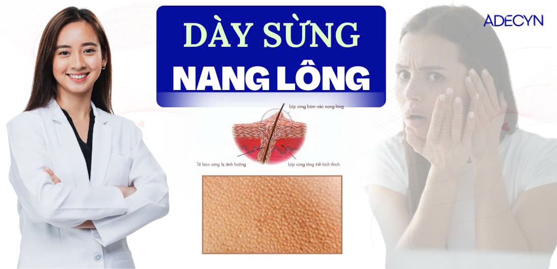 Dày sừng nang lông