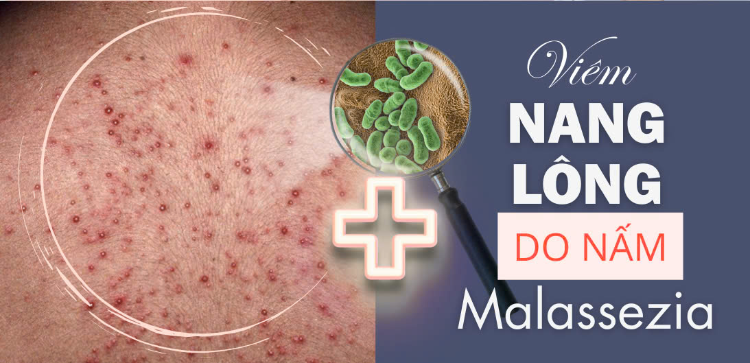 Viêm nang lông do nấm malassezia