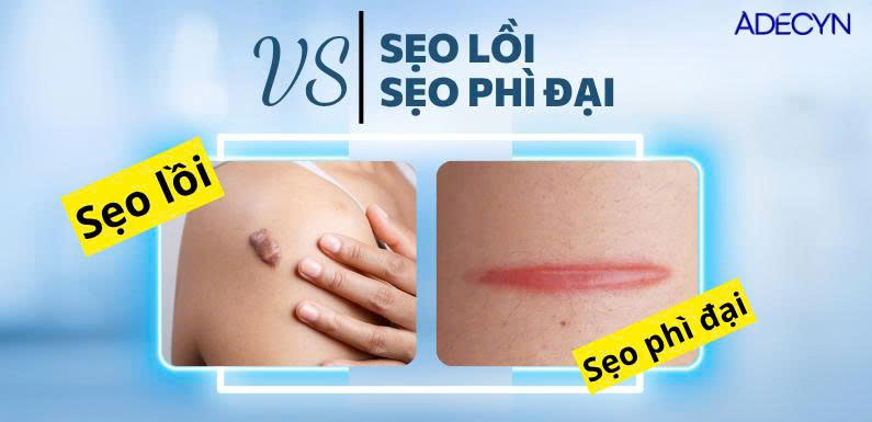 Sẹo lồi và sẹo phì đại
